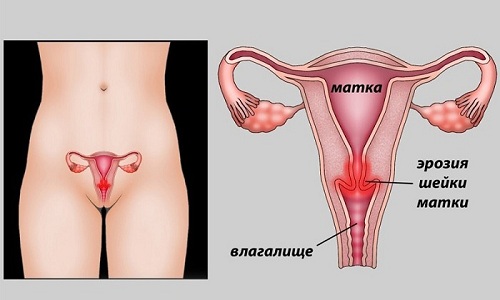Синдром раздраженного кишечника часто сочетается с эрозией шейки матки