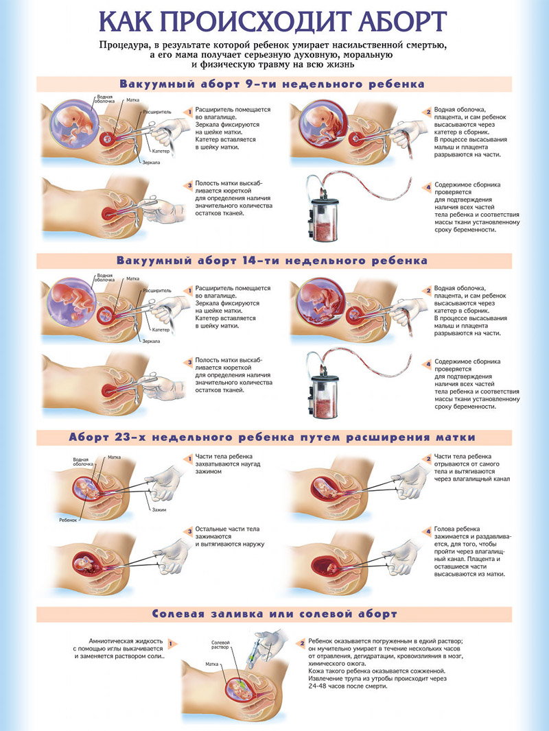 Вакуумный аборт - как делается?