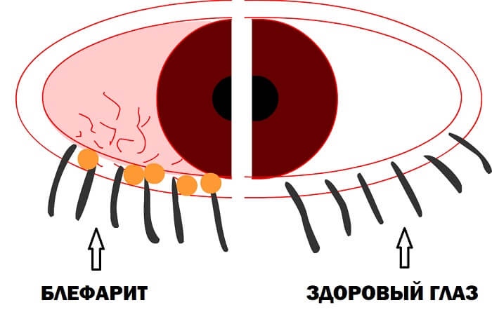 Здоровый глаз и блефарит