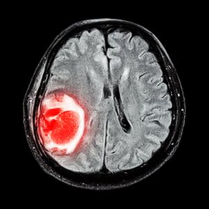 Снимок МРТ опухоли мозга