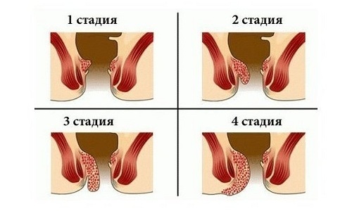 Показание к кесареву сечению - запущенный геморрой (4 стадия)