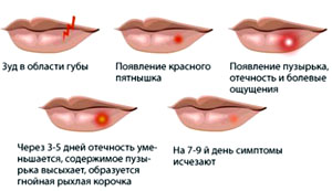 Появления герпеса на губах в 3 триместре