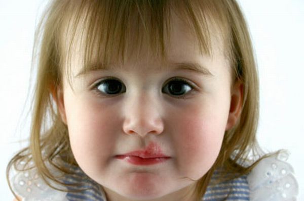 Как лечить простуду на губах у детей?