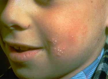 Высыпание герпесных пузырей на щеке у ребенка