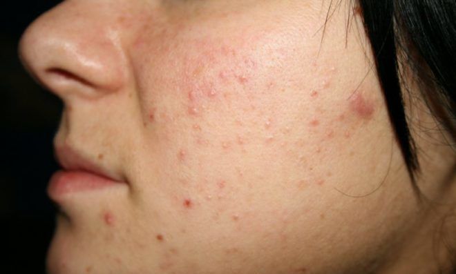 Препарат Гевиксон может вызвать побочные эффекты такие как высыпание на коже