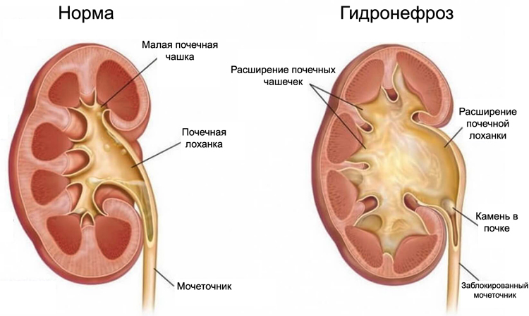 Гидронефроз почек у новорожденных и детей от года: симптомы, лечение и исход заболевания