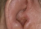 Народное лечение болезней ушей
