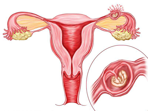 Менструация при внематочной беременности у женщины