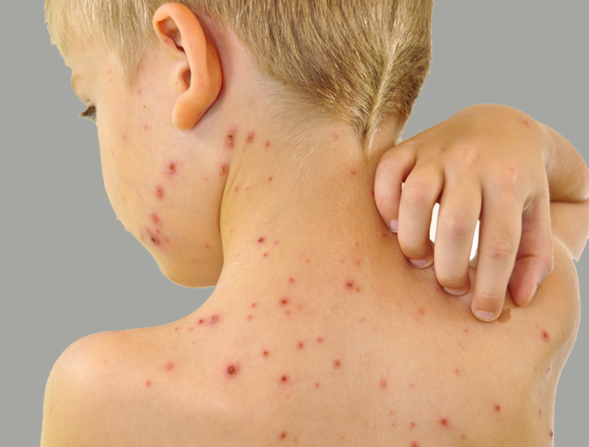 Импетиго у детей: фото, лечение и описание разных видов (стрептококковое, буллезное)