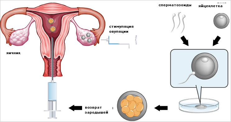 Как делают ЭКО: каким образом проходит процедура искусственного оплодотворения от начала до конца?