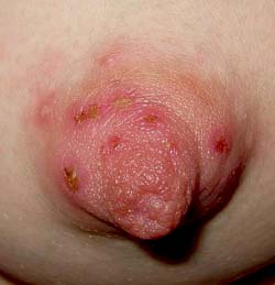 Трещины сосков