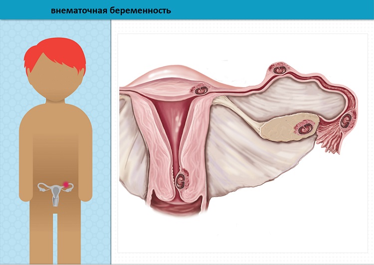 Как диагностируют внематочную беременность
