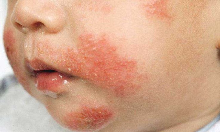 Причины появления дисбактериоза у детей