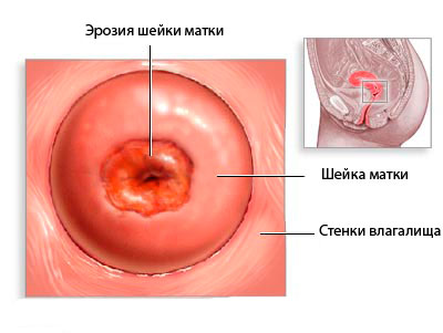 Когда можно забеременеть после прижигания эрозии шейки матки, как протекает беременность и роды?