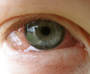 фото больного глаза аллергическим конъюнктивитом