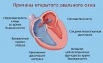 Овальное окно в сердце у грудничка – Открытое овальное окно у грудничка: причины, симптомы и лечение