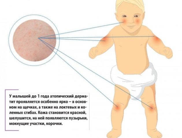 Атопический дерматит у ребенка