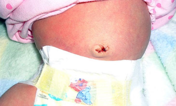 Кровит пупок у новорожденного: что делать, почему кровоточит на 2-3 неделе?