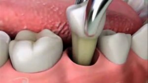 схема удаления зуба