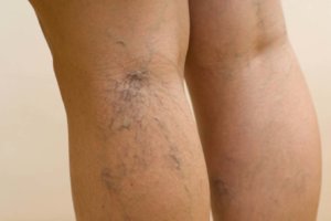 Признаки варикоза ног у женщин: как распознать патологию и начать ее лечить