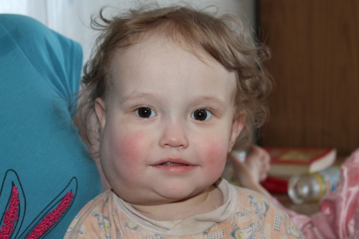 Лимфангиома у детей — причины возникновения патологии, эффективное лечение