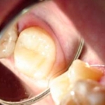 сколько можно держать мышьяк в зубе взрослому