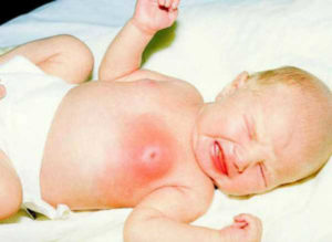 Симптомы гнойного мастита у новорожденных, лечение мастита новорожденных