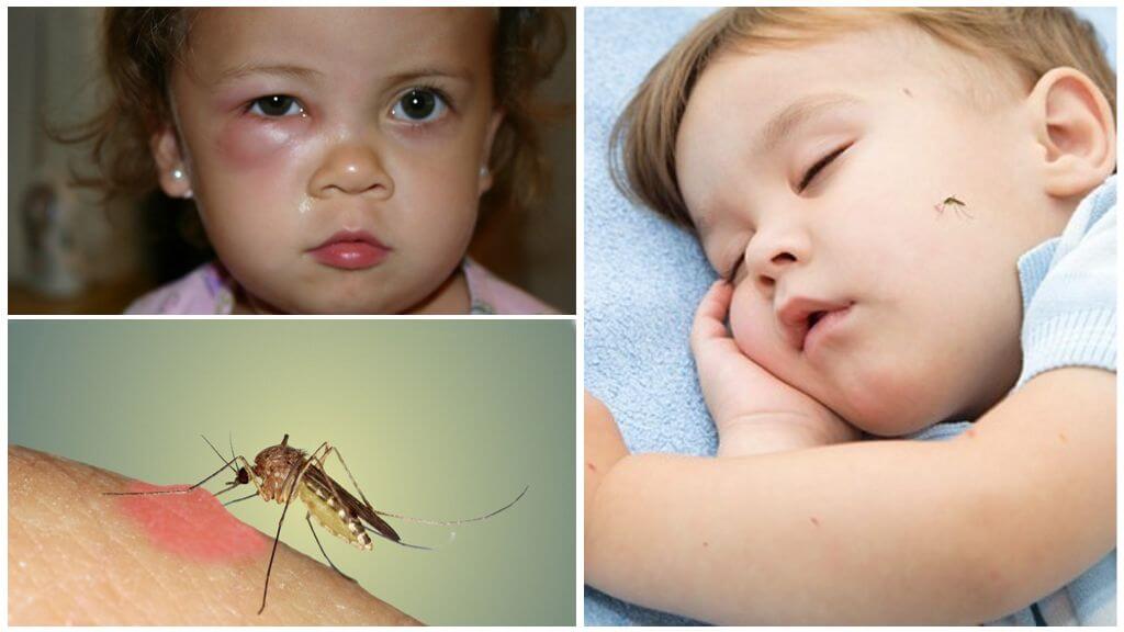 Опух глаз у ребенка от укуса комара