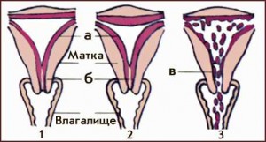 Причины сбоя менструального цикла