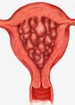 Атипическая железистая гиперплазия эндометрия: причины и симптомы