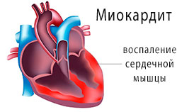 Миокардит — поражение сердечной мышцы, миокарда.