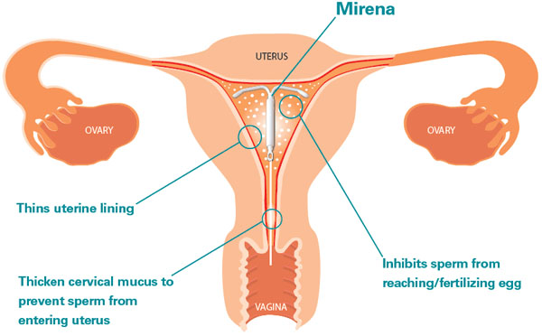 Расположение ВМК в полости матки