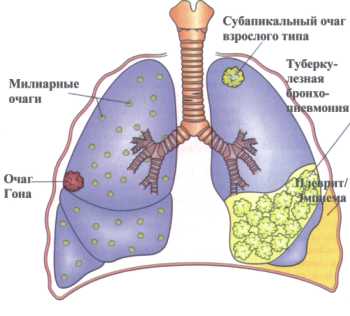 Туберкулез, беременность после туберкулеза