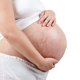 Растяжки во время беременности – почему появляются, как с ними бороться?
