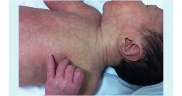 от чего развивается мраморная кожа у новорожденного