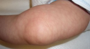 Мраморная кожа врожденная телеангиэктатическая фото 2