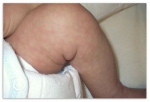 Мраморная кожа врожденная телеангиэктатическая фото 3