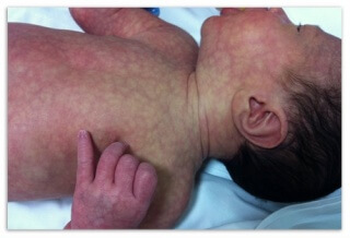 Нормализация цвета кожи новорожденного происходит в первые дни жизни 