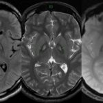 КТ или МРТ головного мозга: отличие методов диагностики, что лучше выбрать?