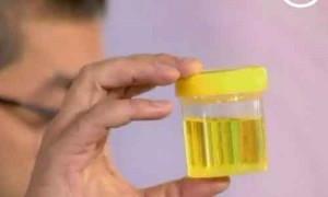 Белые хлопья в моче у мужчин