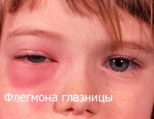У ребенка опух глаз