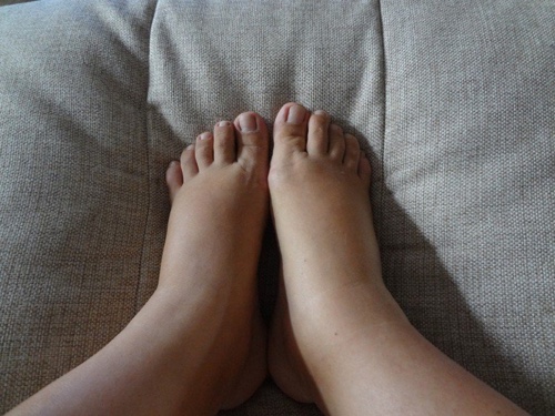 Отеки после кесарева сечения: почему сильно отекают ноги и что делать?