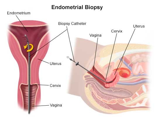 Пайпель биопсии эндометрия - безболезненная процедура