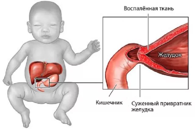 Устройство пищеварительного тракта у новорожденного, как появляется пилороспазм