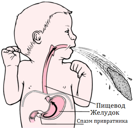 Пилороспазм у новорожденного происходит из-за неправильной работы привратника, поэтому следите за частотой срыгивангий у малыша