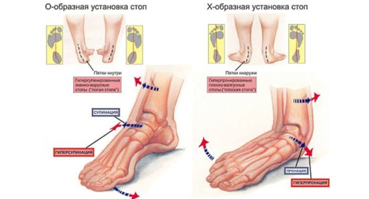 Что такое плоскостопие у ребёнка