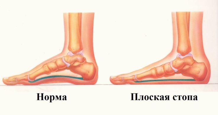 Классификация и причины возникновения плоскостопия