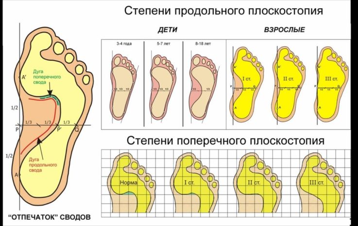 Классификация и причины возникновения плоскостопия у детей