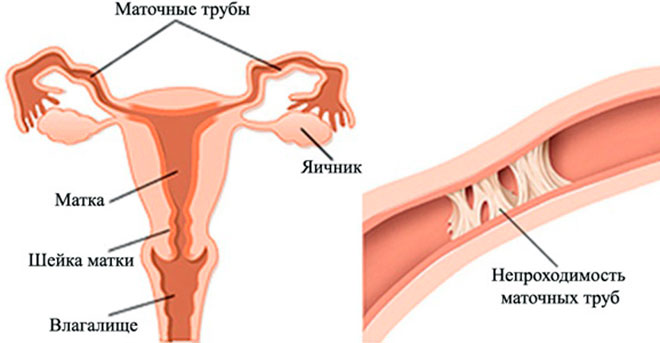 непроходимость фаллопиевых труб