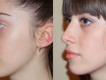 Как сделать горбинку на носу – Горбинка на носу – особенности строения и типы носов с горбинкой; как убрать горбинку